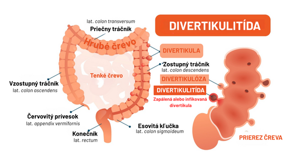 Diverticulitis: when unwanted inflammation arises in the gut.